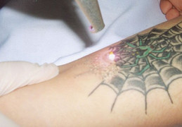 Xóa xăm bằng máy có để lại sẹo không?