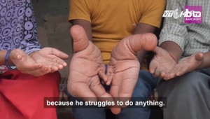 Kinh ngạc cậu bé Ấn Độ có bàn tay khổng lồ nặng 8kg