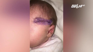 Anh: Bác sỹ sản rạch dao vào đầu trẻ khi mổ đẻ