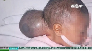 Xót xa bé sơ sinh 2 ngày tuổi có bướu khổng lồ bị người nhà bỏ rơi ở bệnh viện