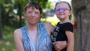 Ngưỡng mộ nghị lực phi thường của người phụ nữ bị chồng bỏ do bỏng xăng biến dạng