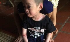 Mắc bệnh hiếm gặp không thể chữa khỏi, bé 5 tuổi ở Phú Thọ cầu cứu trong tuyệt vọng