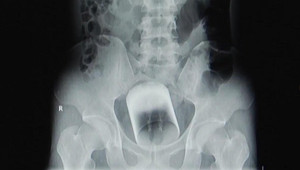 Người đàn ông tự nhét cốc thủy tinh cỡ lớn vào hậu môn khiến bác sỹ choáng nặng