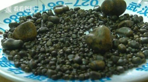 Bác sỹ lấy 806 viên sỏi từ túi mật của bệnh nhân thích ăn thịt mỡ