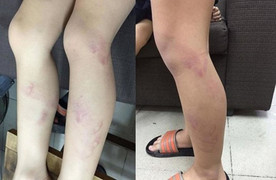 Cô giáo đánh tím chân học sinh do vào lớp chậm: Chủ tịch Hà Nội yêu cầu làm rõ