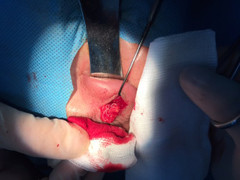 Phát hiện giun ký sinh trong u hốc mắt của bệnh nhân