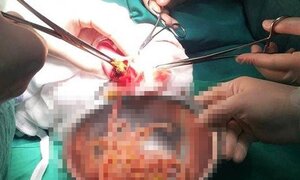 Búi giun hơn 1kg gây tắc ruột bé gái 3 tuổi ở Nghệ An