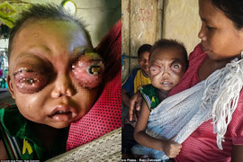 Hình ảnh đau lòng của em bé 2 tuổi bị viêm hốc mắt vô căn