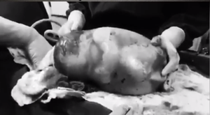 Ngỡ ngàng em bé ra đời vẫn nằm nguyên trong túi nước ối