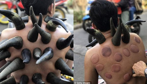 Rùng mình trước cảnh 'cắm' sừng trâu lên lưng, giác hơi chữa bệnh