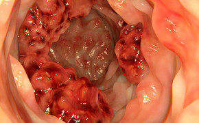 10 thực phẩm giảm nguy cơ ung thư đại trực tràng