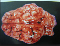 Nguyên nhân bất ngờ gây xuất huyết não, chết người rất nhanh