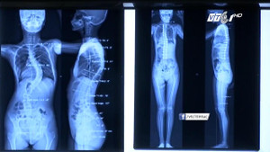 TP.HCM: Hội chứng lạ khiến cột sống thiếu nữ vẹo 69° như chữ S