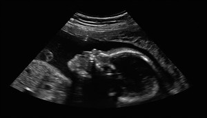 Bố mẹ sốc khi phát hiện con trai mang thai suốt 15 năm