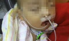 Ăn nhầm thuốc tẩy, bé trai 1 tuổi bị bỏng nặng khắp người