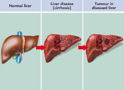 Chữa ung thư gan thế nào để kéo dài sự sống thêm nhiều năm?