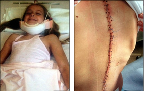 Cận cảnh quá trình phẫu thuật vẹo cột sống