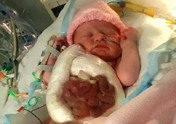 Xót xa hình ảnh bé gái bị xổ ruột bẩm sinh