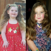 Mắc bệnh lạ, bé gái 7 tuổi bị mãn kinh sớm