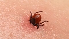 Bị ve cắn từ 16 năm trước, cô gái liệt người, mất trí nhớ