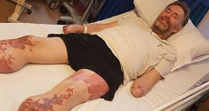 Tưởng chỉ cảm lạnh, người đàn ông phải cắt cụt chân tay chỉ sau 1 ngày