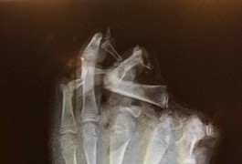 Chơi pháo trong lễ hội, nam thanh niên bị phá nát bàn tay