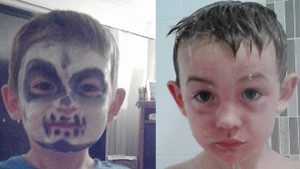 Trang điểm chơi Halloween, bé trai bỏng da mặt