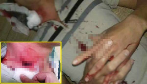 Hòa Bình: Sức khỏe nam thanh niên nghi bị đạn lạc găm trúng cổ giờ ra sao?