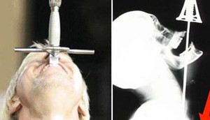 Biểu diễn nuốt lưỡi kiếm dài 60cm, nam thanh niên bị đâm thủng thực quản