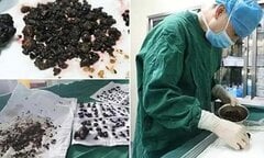 Choáng với 200 viên sỏi mật đen sì trong bụng người phụ nữ nhịn ăn sáng suốt 10 năm