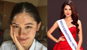 Đại diện Việt Nam bị thuỷ đậu trước chung kết Hoa hậu Quốc tế