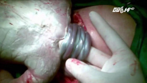 10 giây quyết định cứu sống thai nhi bị 4 vòng dây rốn quấn cổ