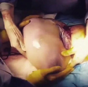 Video ghi cận cảnh ca sinh nở em bé còn nguyên trong bọc ối