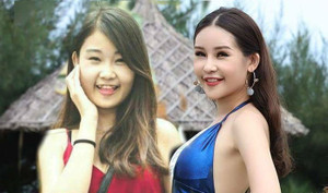 Bác sĩ phẫu thuật thẩm mỹ: 'Hoa hậu Đại dương đã làm mũi, chỉnh hệ xương hàm'