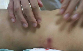 Nhóm thanh niên hỗn chiến, cô gái đi đường bị đạn lạc xuyên thủng bụng