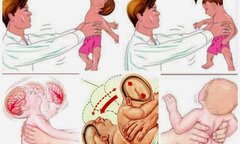 Vụ giúp việc tung hứng bé 1 tháng tuổi: Những nguy cơ sức khỏe em bé phải đối mặt