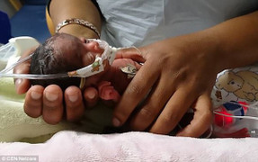 Hy hữu: Bé gái sống sót thần kỳ dù chỉ nặng 400g khi sinh