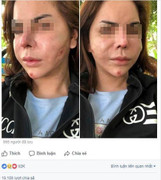 Phát hoảng với khuôn mặt biến dạng lồi lõm của hotgirl sau khi tiêm silicon