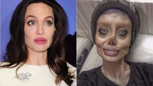 Phẫu thuật để giống Angelina Jolie, cô gái hóa 'xác sống'