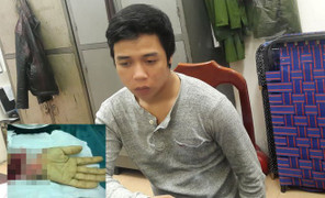 Khách hát karaoke chém đứt bàn tay nhân viên quán