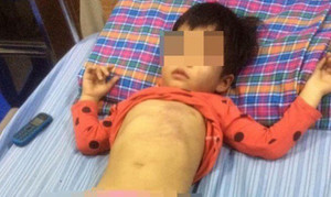 Bé 4 tuổi bị bầm tím thân thể ở Bắc Giang: Bác thông tin cô giáo đánh trẻ