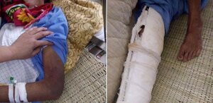 Hay uống rượu, cha bị con trai đánh gãy xương sườn, mẻ xương ống chân