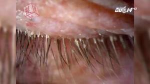 5 năm không giặt gối, bị hơn 100 con rận đẻ trứng, làm tổ trong mi mắt