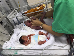 Em bé sinh non 1,7kg, tăng 'thần tốc' lên 5,3kg trong 3 tháng