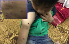 Bé trai học lớp 4 bị bố dùng dây điện đánh dã man