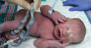Phép màu: Em bé chào đời khỏe mạnh dù dây rốn bị thắt nút rất chặt