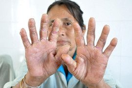 Quảng Ngãi: Nhiều người tái mắc 'bệnh lạ' cực kỳ nguy hiểm