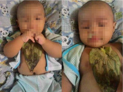 Trị sổ mũi bằng lá trầu, bé gái bị bỏng nặng vùng ngực