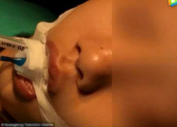 Bé gái 10 tuổi suýt chết vì mẹ nặn mụn đầu đen