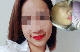 Cô gái Sài Gòn bị mù mắt, liệt nửa người sau tiêm filler nâng mũi
